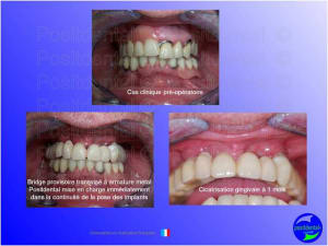 Mise en chage imm diate 052 hu2usj - Eugenol