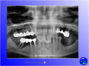 Mise en chage imm diate 057 zcnyhw - Eugenol