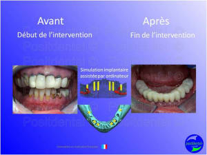 Mise en chage imm diate 105 jovyyx - Eugenol