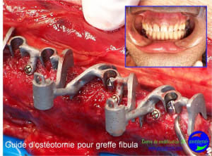 Mise en chage imm diate 119 acfkfo - Eugenol