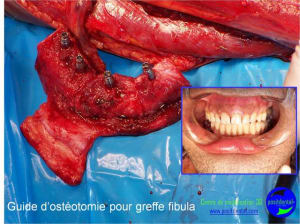 Mise en chage imm diate 120 d831dg - Eugenol