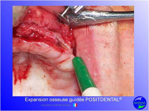 Mise en chage imm diate 142 ht7h1r - Eugenol