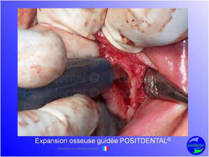 Mise en chage imm diate 143 kgvukm - Eugenol
