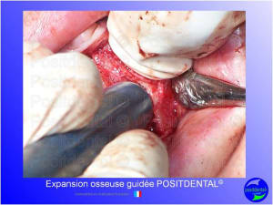 Mise en chage imm diate 144 uwlvtp - Eugenol