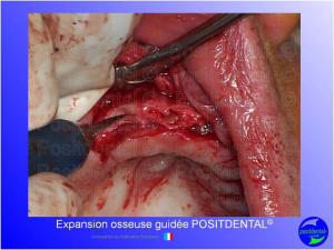 Mise en chage imm diate 151 jhp1hk - Eugenol