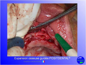 Mise en chage imm diate 152 yjrgkn - Eugenol