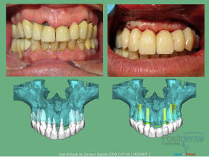 Mise en charge immédiade c - Eugenol