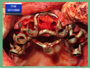 Mise en charge immédiade c - Eugenol