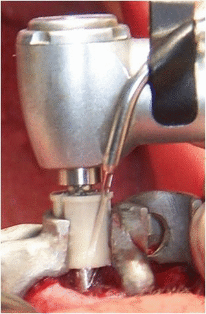 Mise en charge immédiate extraction implantation mci positdental 030 x0aloh - Eugenol