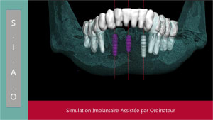 Mise en charge immédiate   protocole positdental 007 th4eic - Eugenol