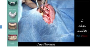 Mise en charge immédiate   protocole positdental 010 ihv76a - Eugenol