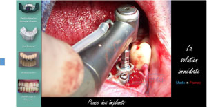 Mise en charge immédiate   protocole positdental 016 cvup7t - Eugenol