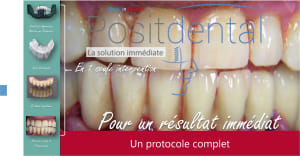 Mise en charge immédiate   protocole positdental 021 ehr7zf - Eugenol