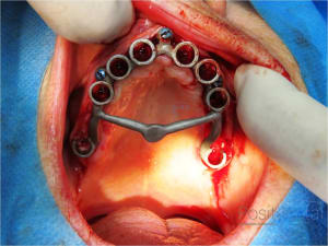 Mise en charge immédiate chirurgie guidée 012 oog5ql - Eugenol