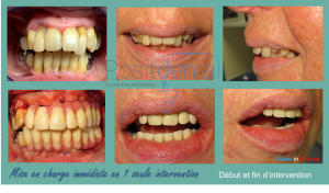 Mise en charge immédiate en 1 seule intervention la solution immédiate positdental 010 xzb3e7 - Eugenol