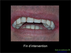 Mise en charge immédiate implant dentaire 018 ocnqvh - Eugenol