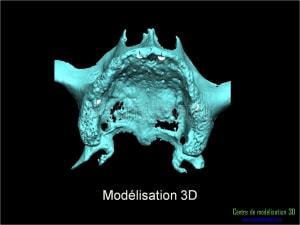 Mise en charge immédiate implant dentaire 023 pzwxmz - Eugenol