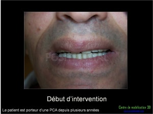 Mise en charge immédiate implant dentaire 024 acrklx - Eugenol