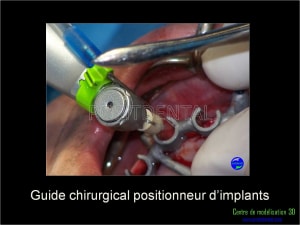 Mise en charge immédiate implant dentaire 034 rkk0pl - Eugenol