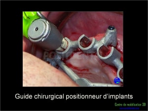 Mise en charge immédiate implant dentaire 038 v26a5i - Eugenol