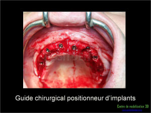 Mise en charge immédiate implant dentaire 043 qceqh3 - Eugenol