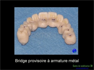 Mise en charge immédiate implant dentaire 047 xhxlgl - Eugenol