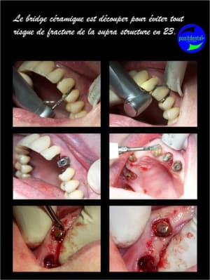 Mise en charge imm diate bridge provisoire sur implants 1 rgq3l4 - Eugenol