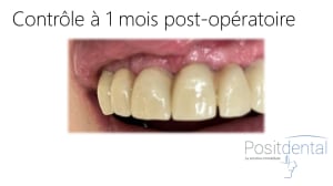 Mise en charge innédiate positdental 011 ekrcnv - Eugenol