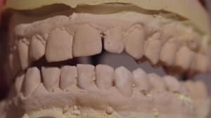 Occlusion r elle face gtpowg - Eugenol