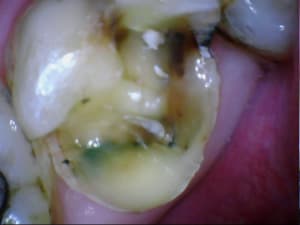 Onlay ou pas f6vepj - Eugenol