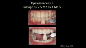 Opalescence go nlfset - Eugenol