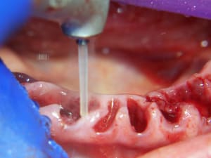 Positdental 141120 140 nysaod - Eugenol