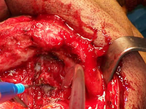 Positdental 141229 023 tusx7s - Eugenol