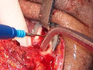 Positdental 141229 066 ptqacf - Eugenol