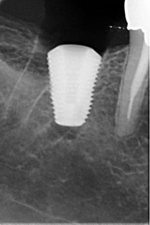 Post op ovqg5u - Eugenol