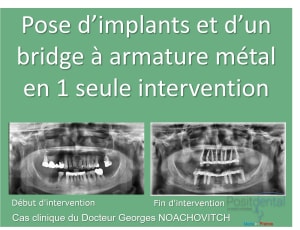 Pose d implants et d un bridge à armature métal en 1 seule intervention g - Eugenol