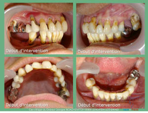 Pose d implants et d un bridge à armature métal en 1 seule intervention g - Eugenol