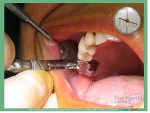 Pose d implants et d un bridge à armature métal en 1 seule intervention g - Eugenol