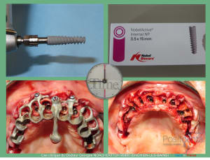 Pose d implants et d un bridge à armature métal en 1 seule intervention g - Eugenol