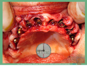 Pose d implants et d un bridge à armature métal en 1 seule intervention g - Eugenol
