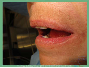 Pose d implants et d un bridge à armature métal en 1 seule intervention g - Eugenol