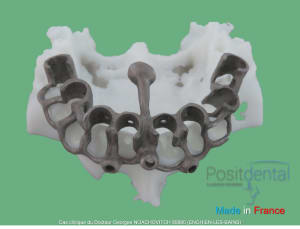 Pose d implants et d un bridge à armature métal en 1 seule intervention g - Eugenol