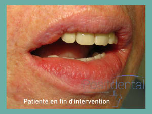 Positdental mise en charge immédiate 015 nxmpb9 - Eugenol