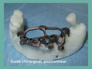 Positdental mise en charge immédiate 017 wdphmg - Eugenol