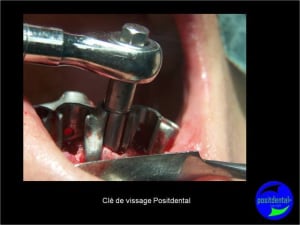 Protocole mci post extractionnelle positdental 017 iypwe7 - Eugenol