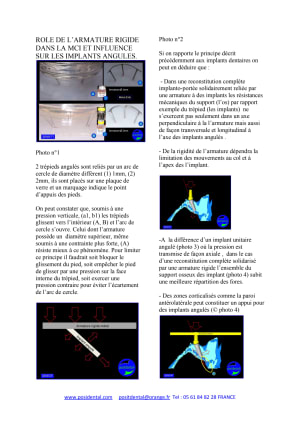 R le de l armature rigide dans la mci et influence sur les implants angul s - Eugenol
