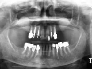Radiographie n 2 az6ynv - Eugenol
