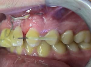 Trauma 3 q3dmlp - Eugenol