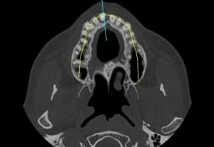Axial t8dzmd - Eugenol