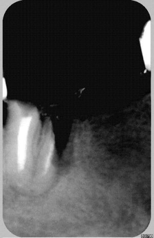 Bin non apex soudés of5ewm - Eugenol